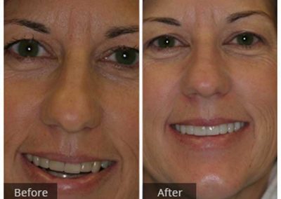 Teeth whitening Before & After